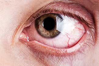 Dry Eye Treatment Thumbnail